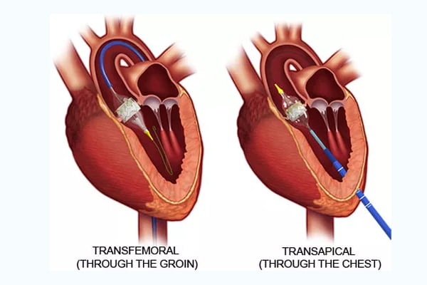 In the TAVI procedure, a catheter is passed to the heart with an incision in the transfemoral or transapical femoral artery.
