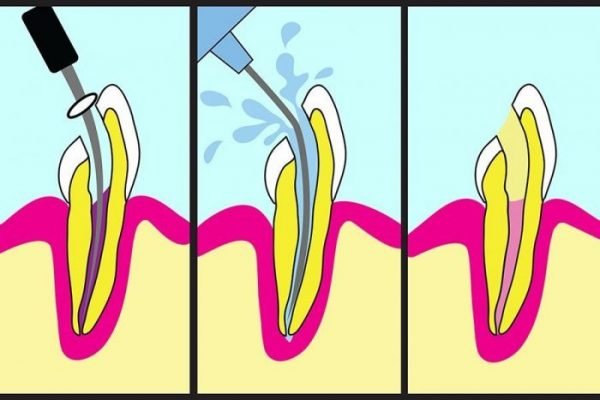 A root canal is performed and the post is placed into the root, the core is shaped around it and a crown is then fitted.