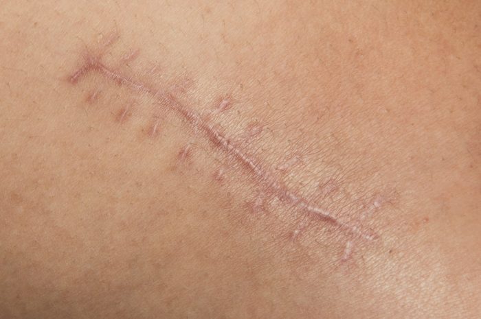 A scar forms after an injury whereby fibrous tissue replaces the normal skin as the wound heals.