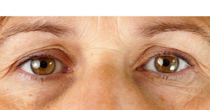 Eye bag treatments target puffy eyes, dark circles, and sagging skin.