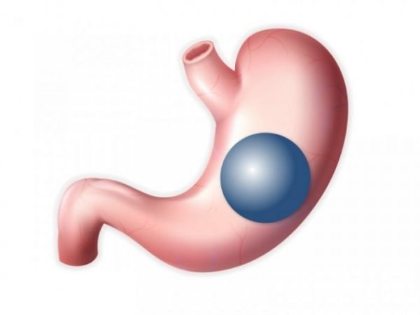 Gastric balloon treatment is a short-term weight loss treatment which creates a feeling of being full after eating.