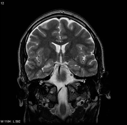 An MRI scan of the brain creates images from every angle of the brain.