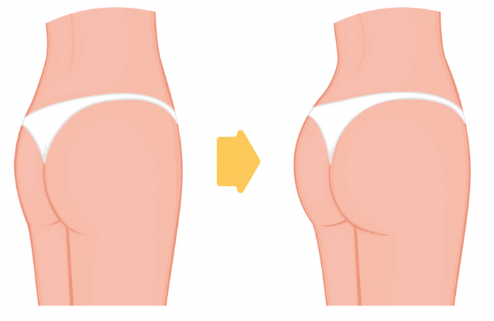 Recently, women who want a better image on their hips prefer butt lift.
