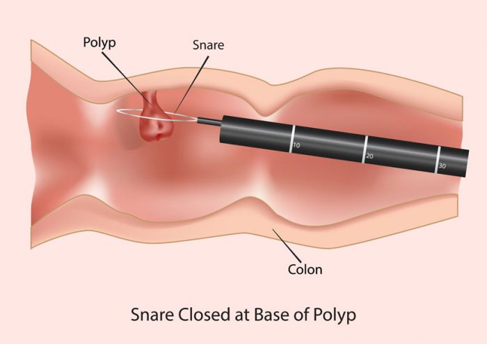 The device used to remove polyps and other unnecessary tissues with high frequency electricity in the presence of an endoscope is called a snare.