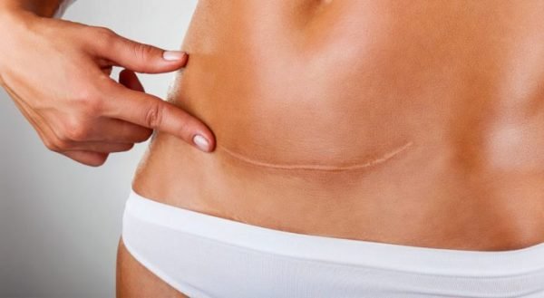 An abdominoplasty redefines the abdomen and makes it firmer.