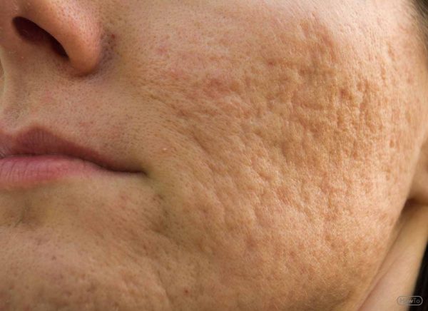 Acne most commonly occurs during adolesence and can leave scars after it has cleared up.