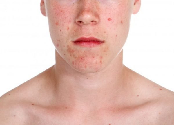 Acne can appear in the form of blackheads, whiteheads, red bumps or as cysts.