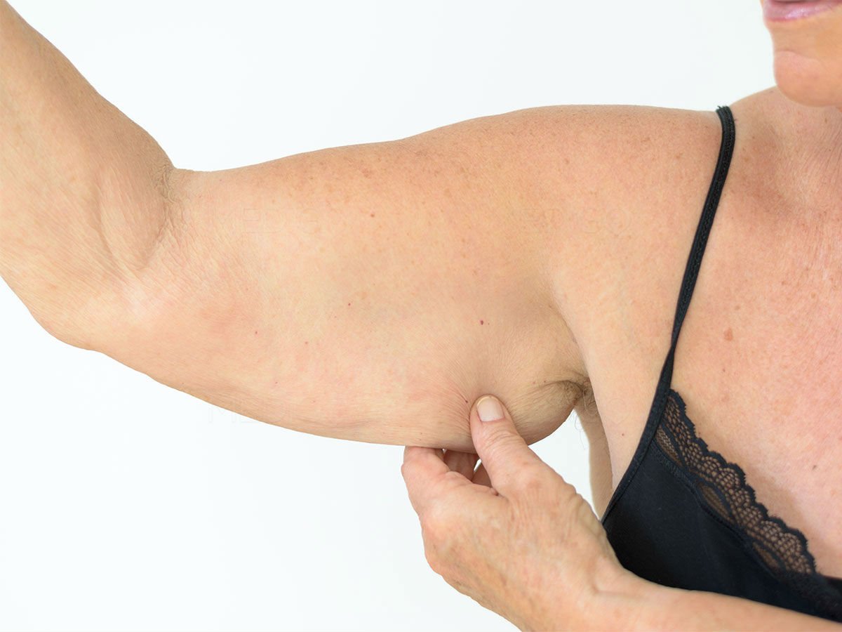 Many people who have lost weight or who are unhappy with their appearance choose to have an arm lift to reshape the arm.