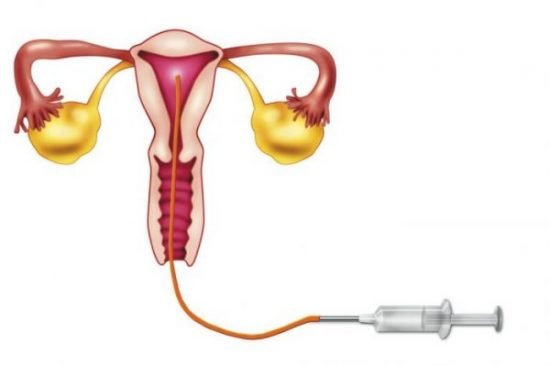 The semen is introduced directly into the vagina or uterus.