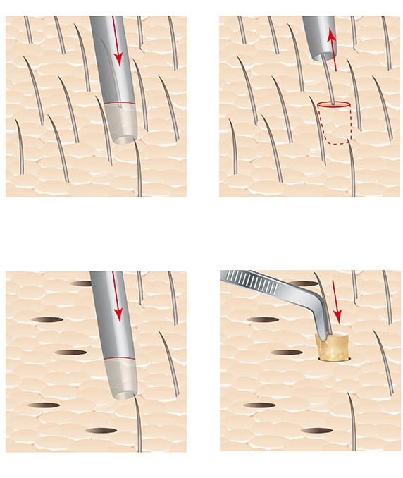 Hair is extracted from the donor site and then transplanted to the target area (as shown above).