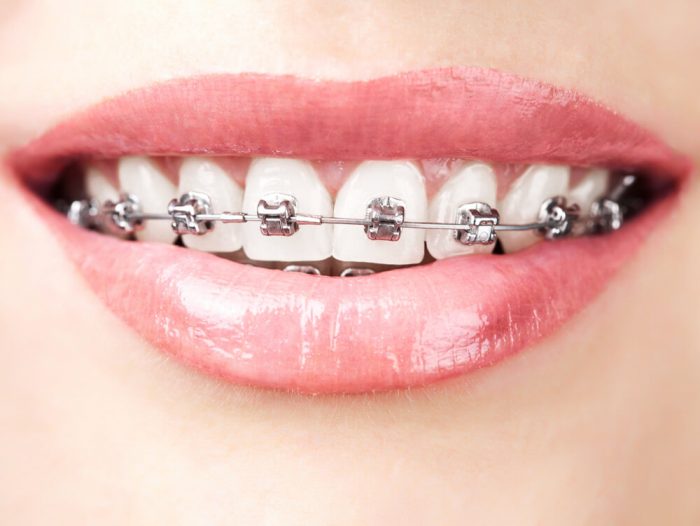 Braces are usually worn between 6 and 12 months.
