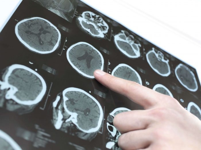 Before surgery is considered, an MRI or CT scan of the brain is taken to establish the size and location of the tumor.