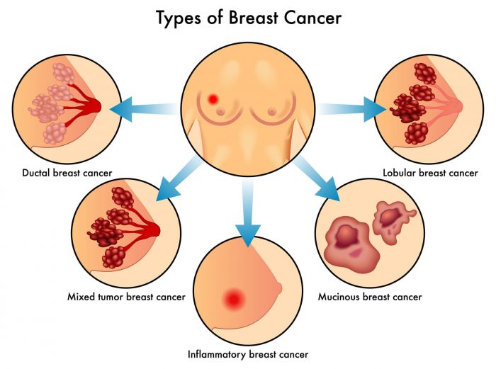 What Are the Different Types of Breast Cancer: Common, Rare, Treatment