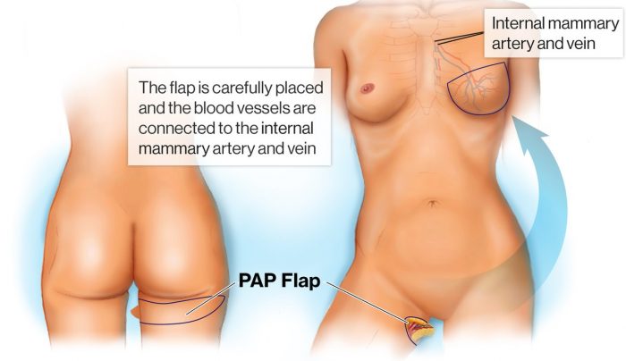 Best Breast Reconstruction in India - topplasticsurgery