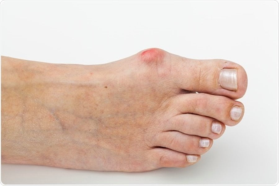 A bunion is a deformity of the big toe whereby a bump forms on the bone and causes pain and discomfort.