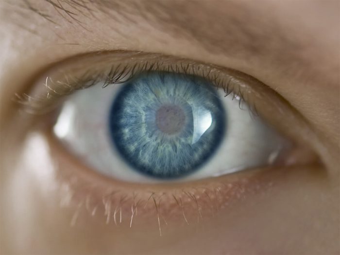 Cataracts appear as a cloudy patch on the lens of the eye.