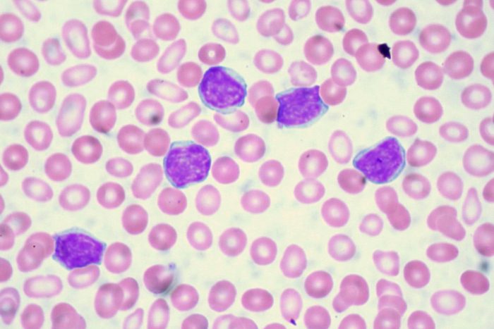 Leukemia is a type of cancer that affects the blood cells in the body.