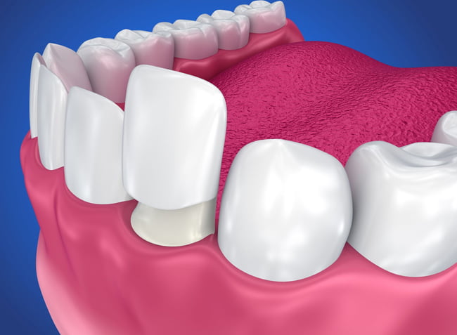 Crowns can help to salvage a damaged and decayed tooth.