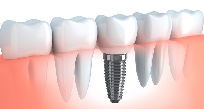 A dental implant replaces a natural tooth.