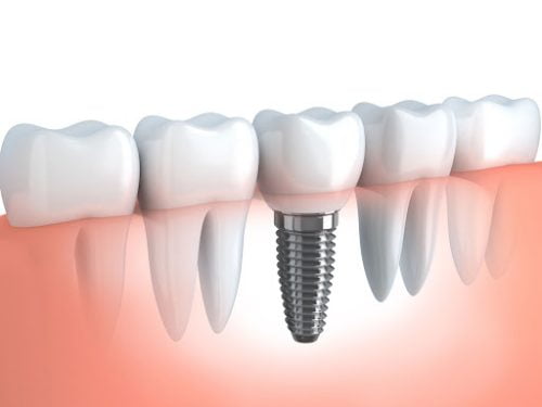 A dental implant replaces a natural tooth.