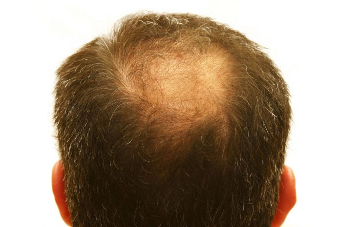 Hair loss treatments are recommended for patients with thinning hair, rather than complete hair loss.