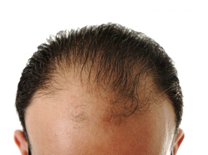 Hair transplantation is commonly performed on patients suffering with male-pattern baldness.