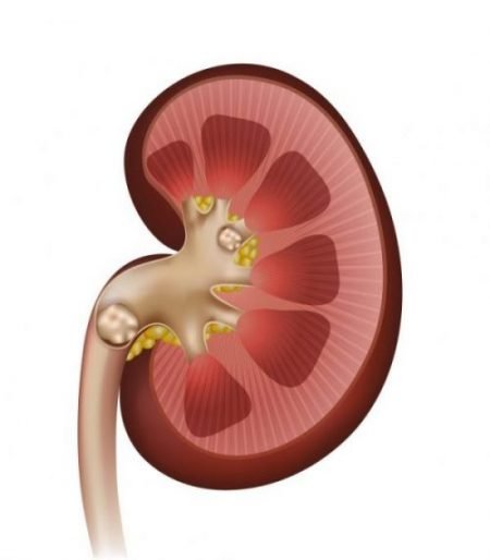Kidney stones are caused by a build up of salts and minerals in the kidneys.