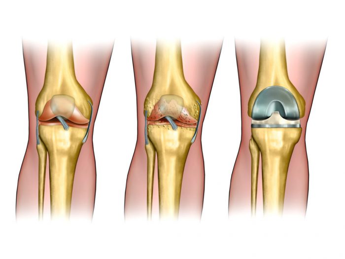 Knee replacement surgery is performed when the joints in the knee are not functioning correctly.