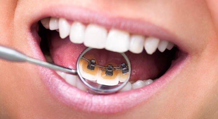 Lingual braces offer the strength of normal metal braces, while being a discreet, esthetic alternative.