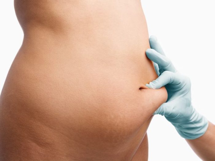 Liposuction is the surgical removal of excess fat from the body.