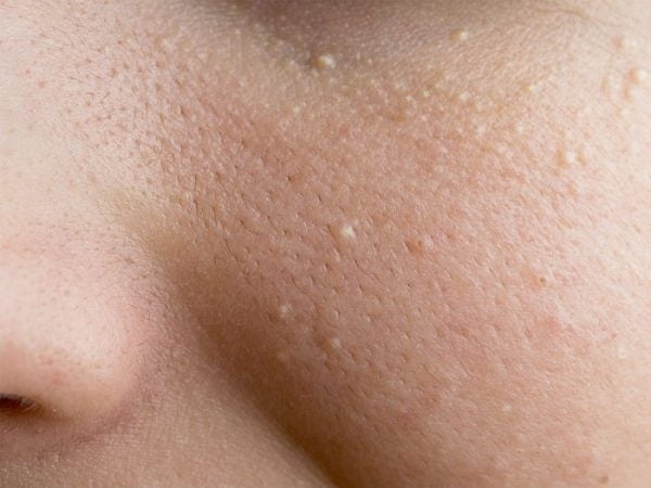 Milia commonly appear on the skin of the nose and eyes.