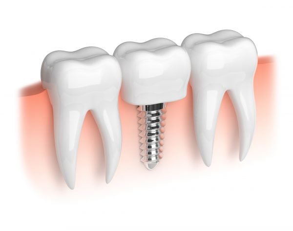 A mini implant is a good option to fill a narrow gap in the teeth.