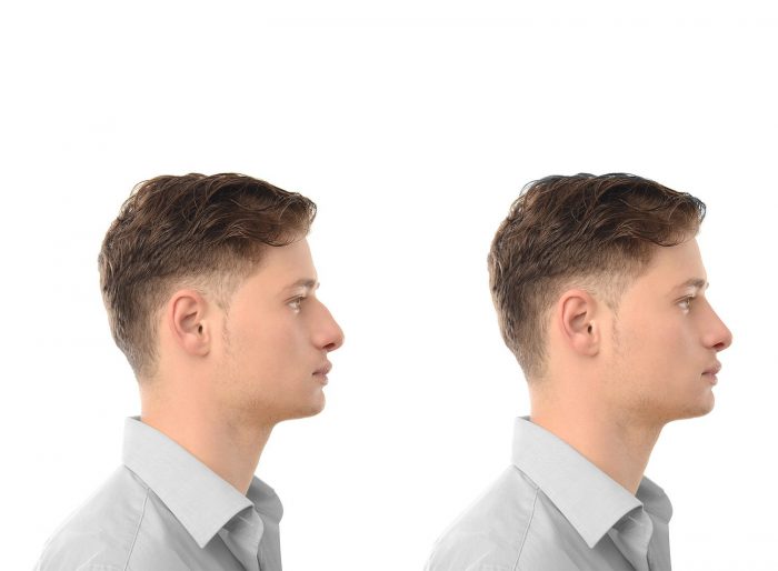 The surgeon reshapes the nose into the desired shape or size.