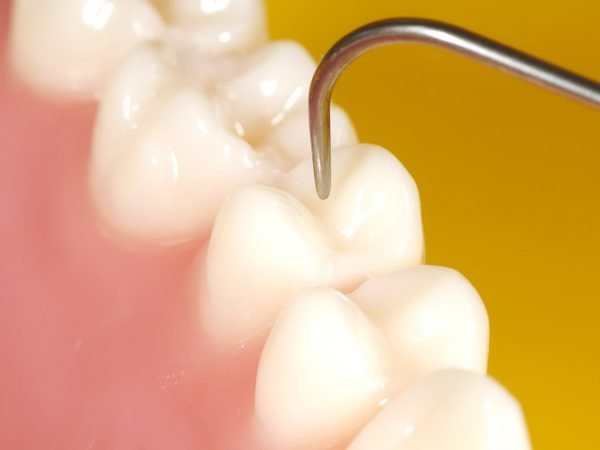 Filling the fissures in the tooth prevents food from getting stuck and prevent the formation of cavities.