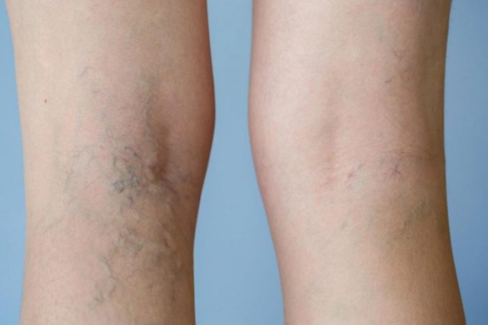 Varicose veins have a weakened wall and become swollen and twisted.