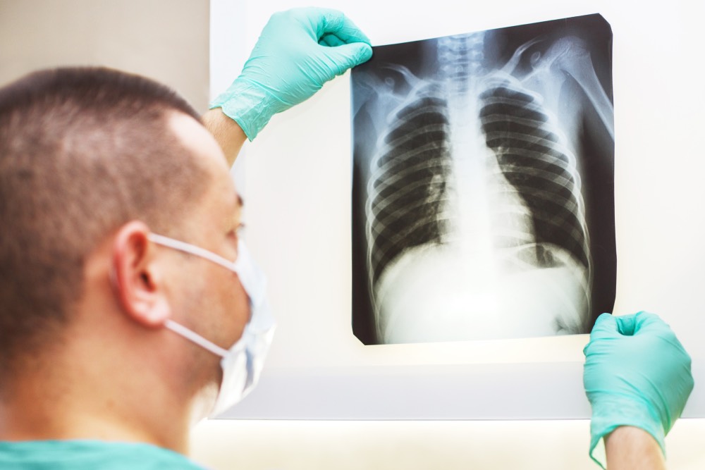 Akciğer Filmi (Röntgeni) Nasıl Çekilir?