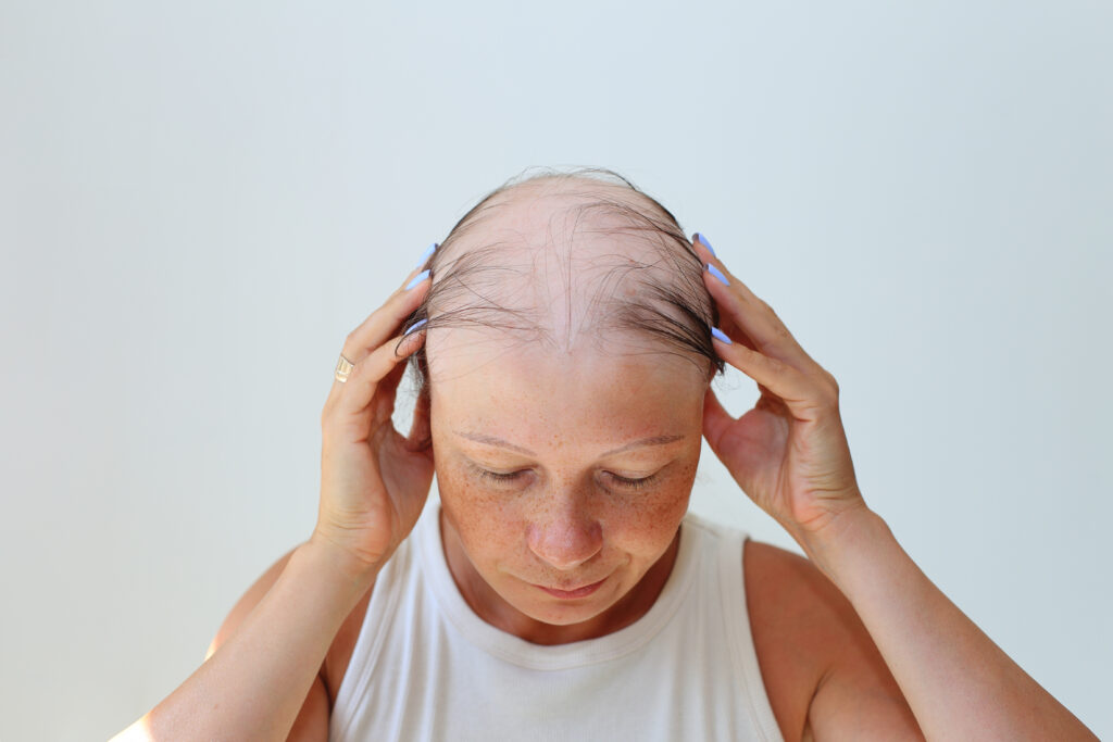 donna con diradamento da alopecia da stress