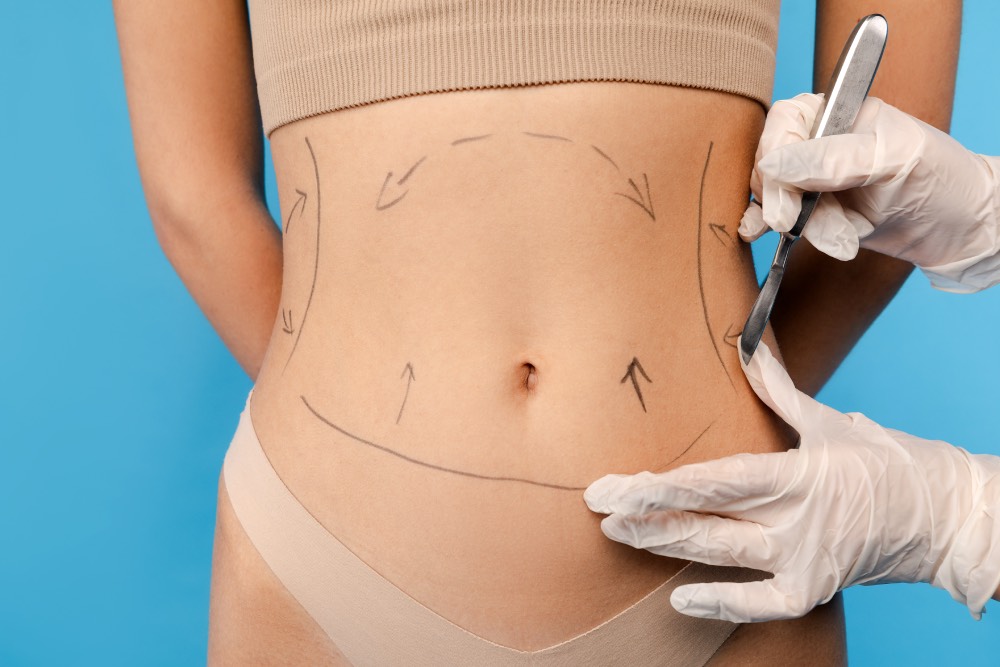 Karın Liposuction Ameliyatı Öncesi