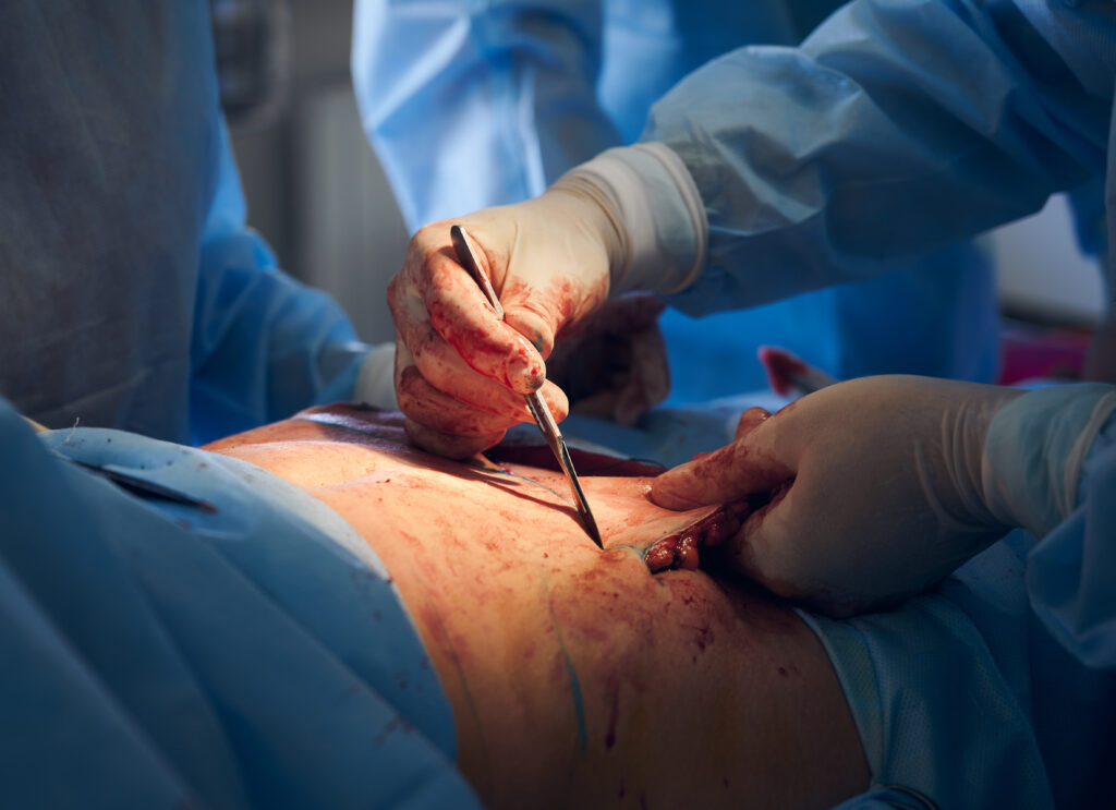 operazione di sleeve gastrectomy