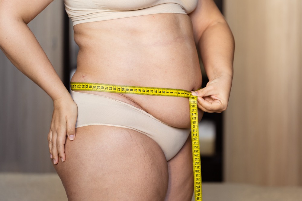 Obezite Kaç Kiloda Ameliyat Gereklidir?