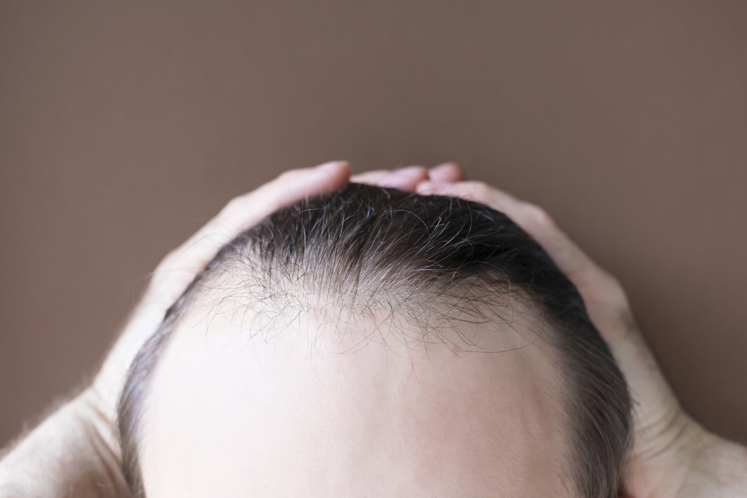 uomo con alopecia prima dell'operazione di trapianto di capelli